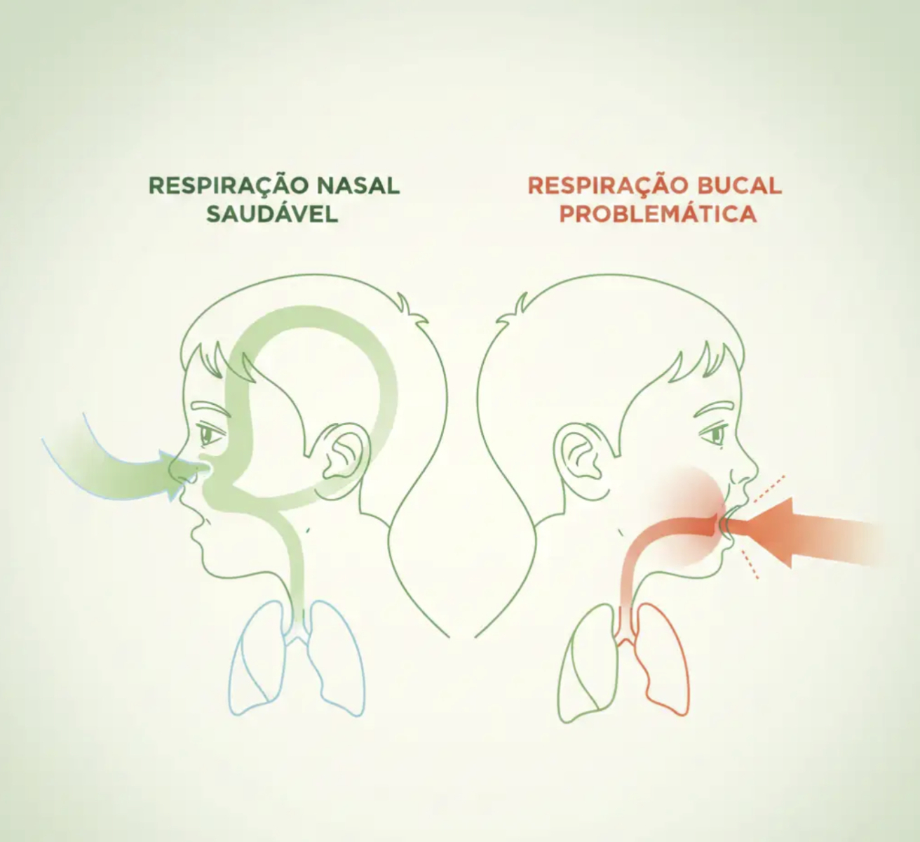 Ronco Infantil Não É Normal: O Que a Respiração Bucal Revela